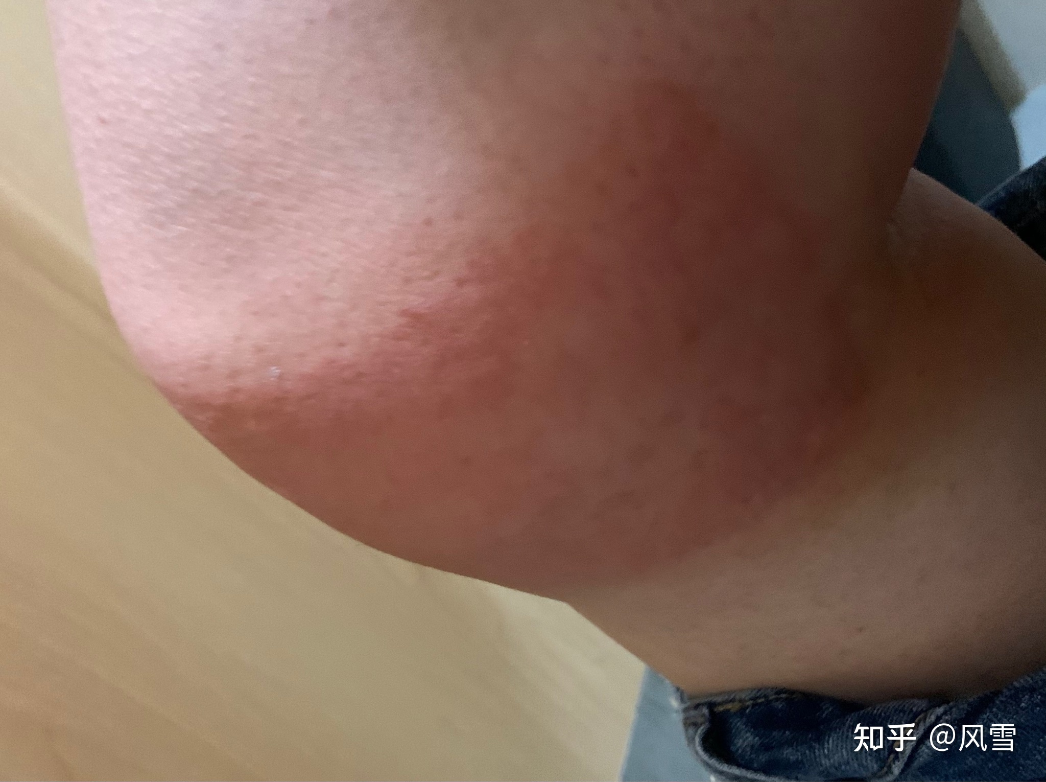 1、贴膏药过敏痒红肿怎么办？